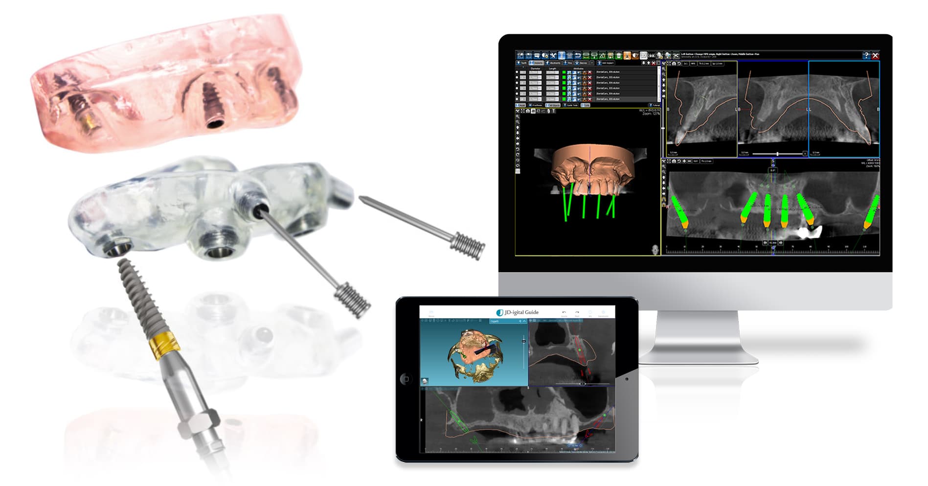 Guided Implant Systems